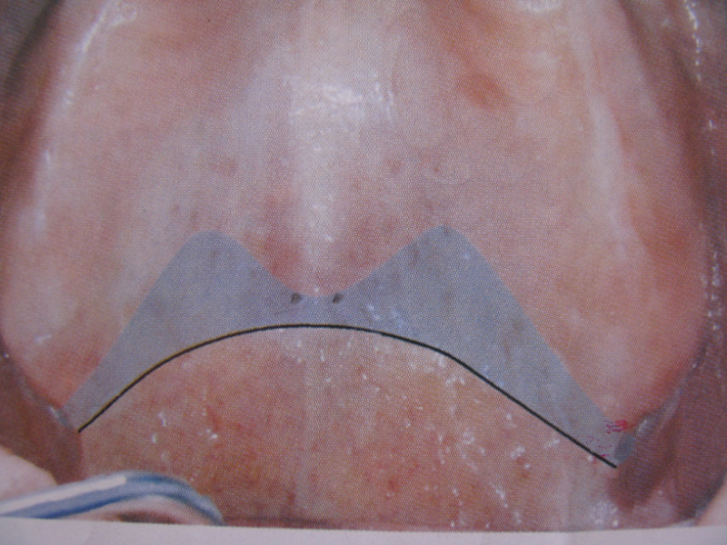 腭小凹是软硬腭结合处,中线两侧的两个凹陷是腭部小黏液腺导管的开口