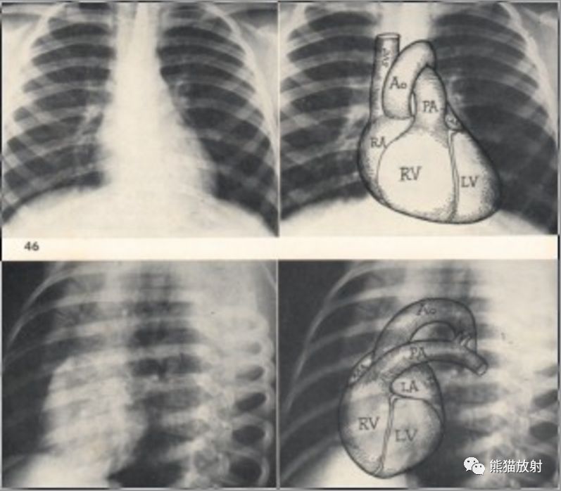 正常心脏和大血管的x线表现