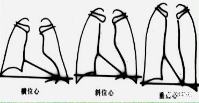 取决于体型,横膈高度和呼吸状态等因素,大致可归为三种类型①垂位心