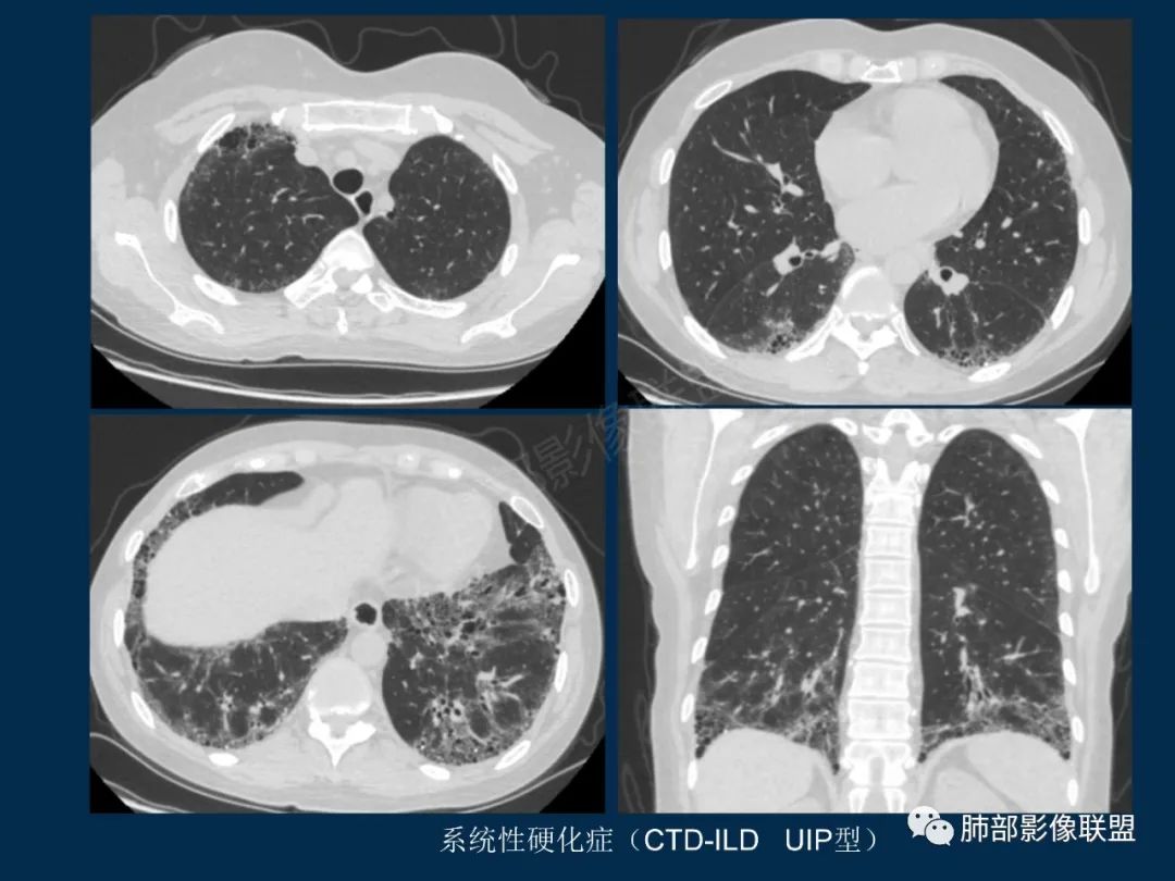 特发性间质性肺炎的病理影像特点