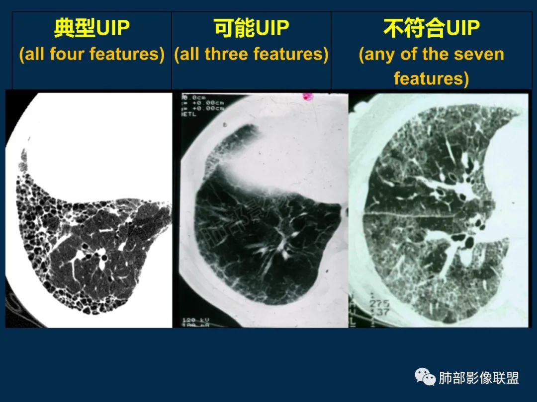 特发性间质性肺炎的病理影像特点