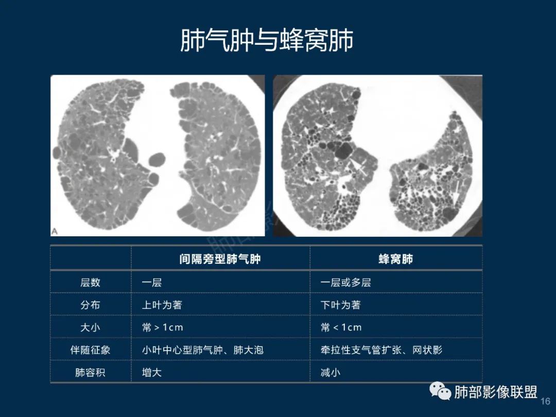 特发性间质性肺炎的病理影像特点