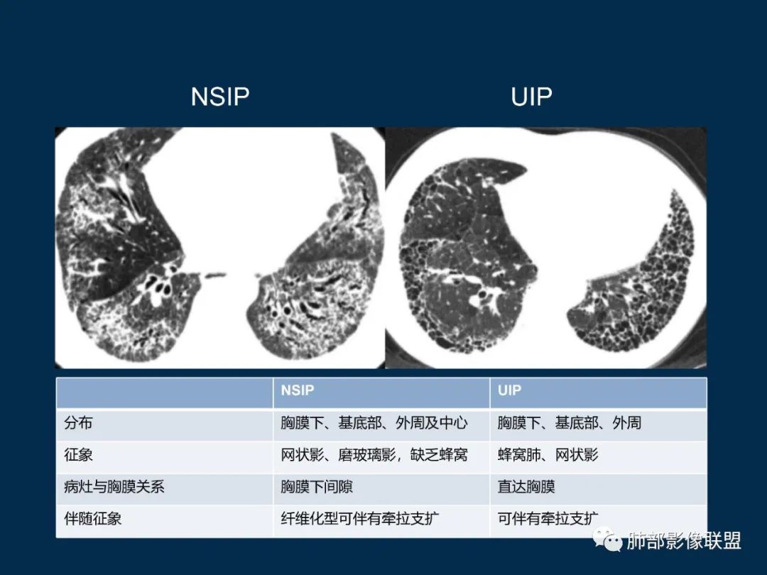 特发性间质性肺炎的病理影像特点