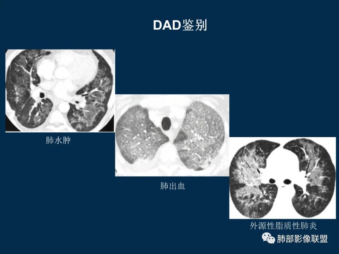 特发性间质性肺炎的病理影像特点