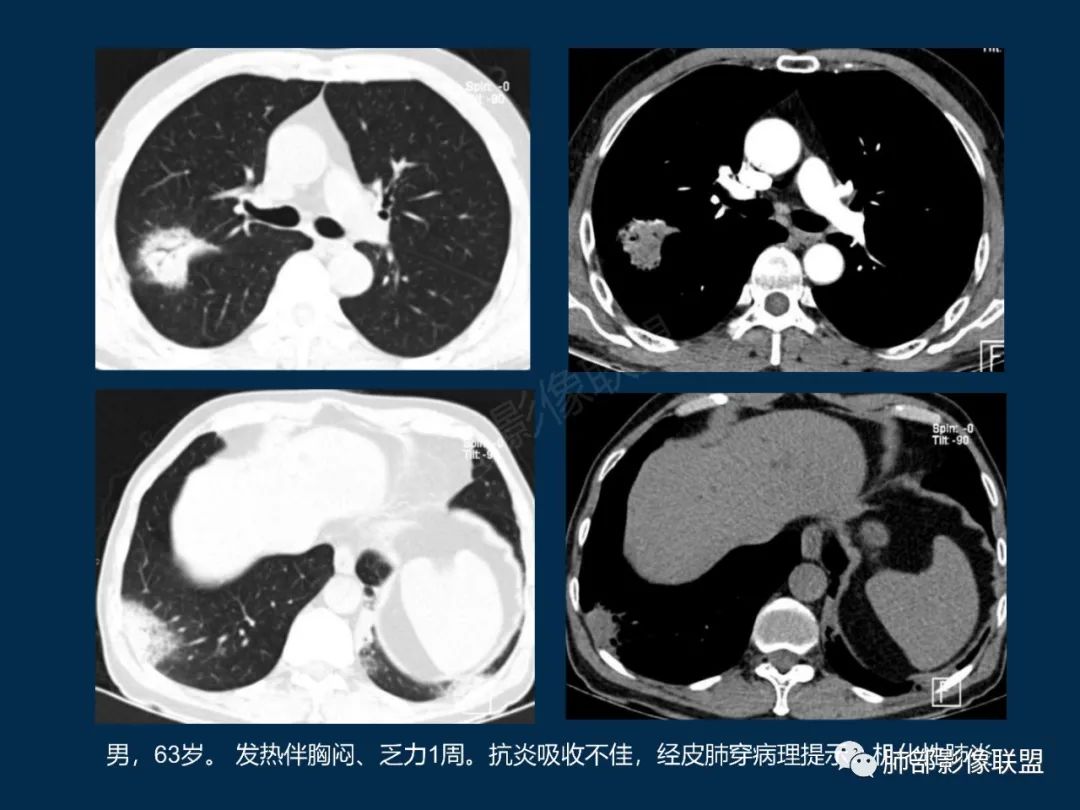 特发性间质性肺炎的病理影像特点