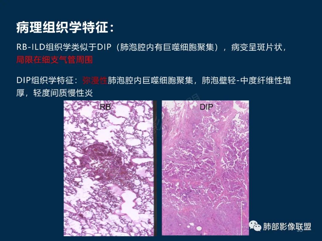 特发性间质性肺炎的病理影像特点