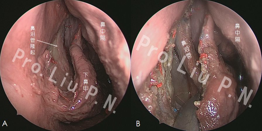 术后mri 八,手术案例5-经鼻-上颌窦入路 (泪前隐窝入路) 切除颞下窝