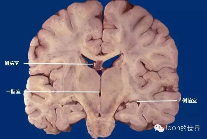 美图联播▏史上最全三脑室解剖图谱