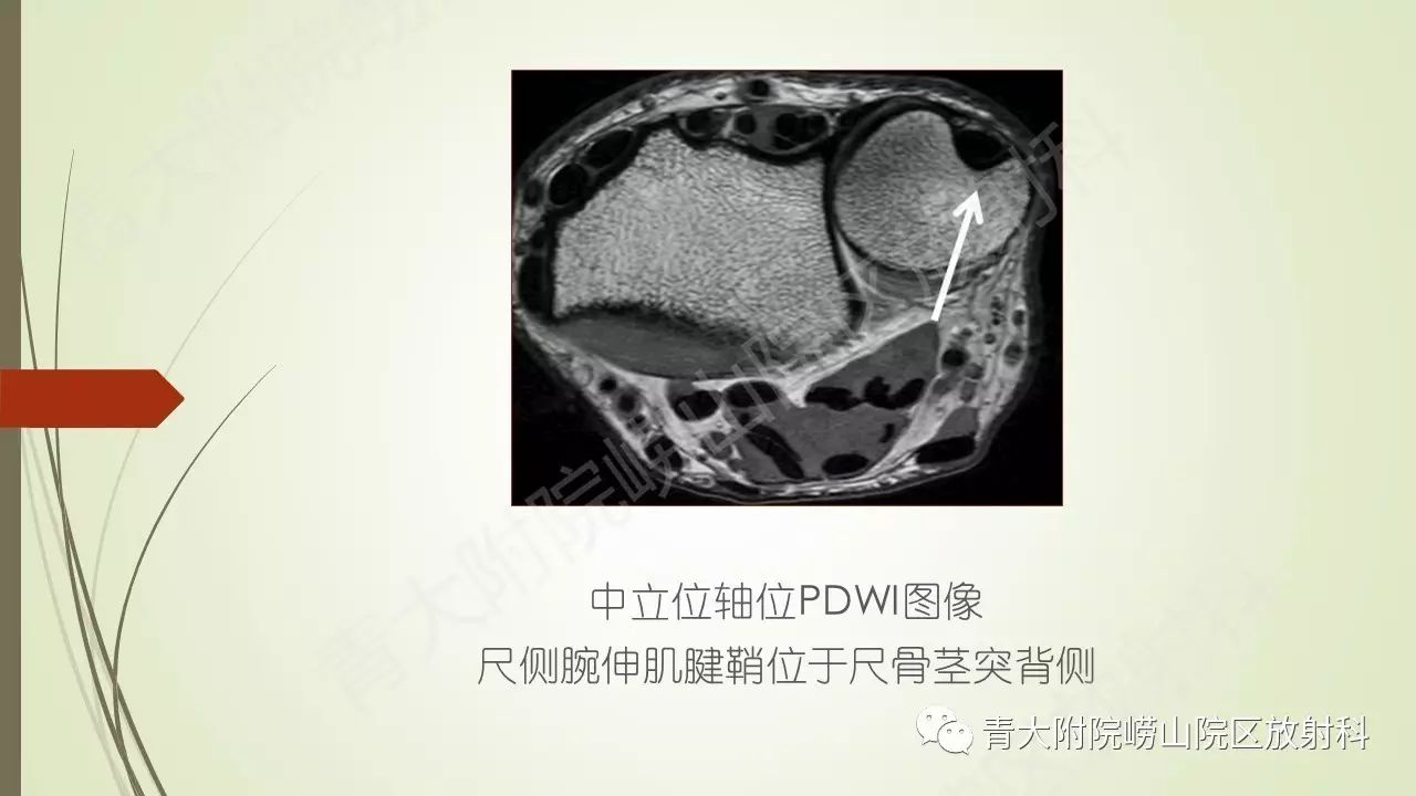 解剖学系列讲座六三角纤维软骨复合体