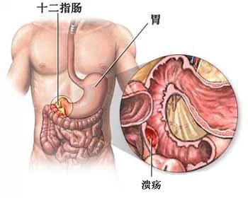 胃炎胃溃疡胃出血的特效偏方