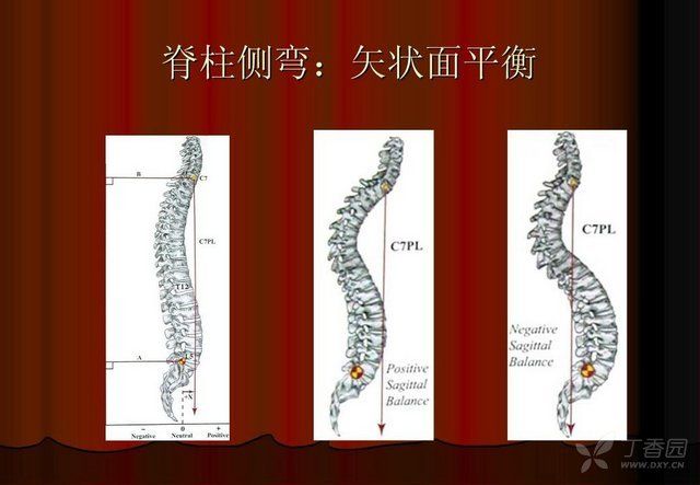 脊柱侧弯的lenke分型