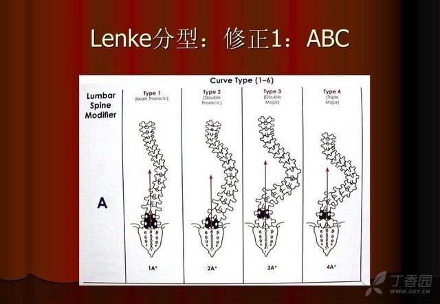 脊柱侧弯的lenke分型