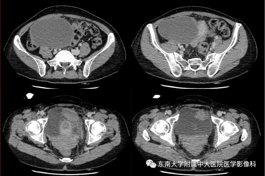 精彩推荐 | 子宫内膜异位症影像表现