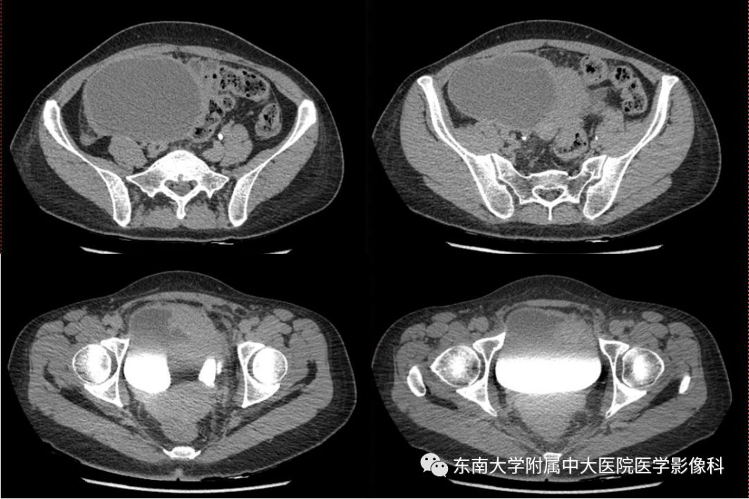 精彩推荐 | 子宫内膜异位症影像表现