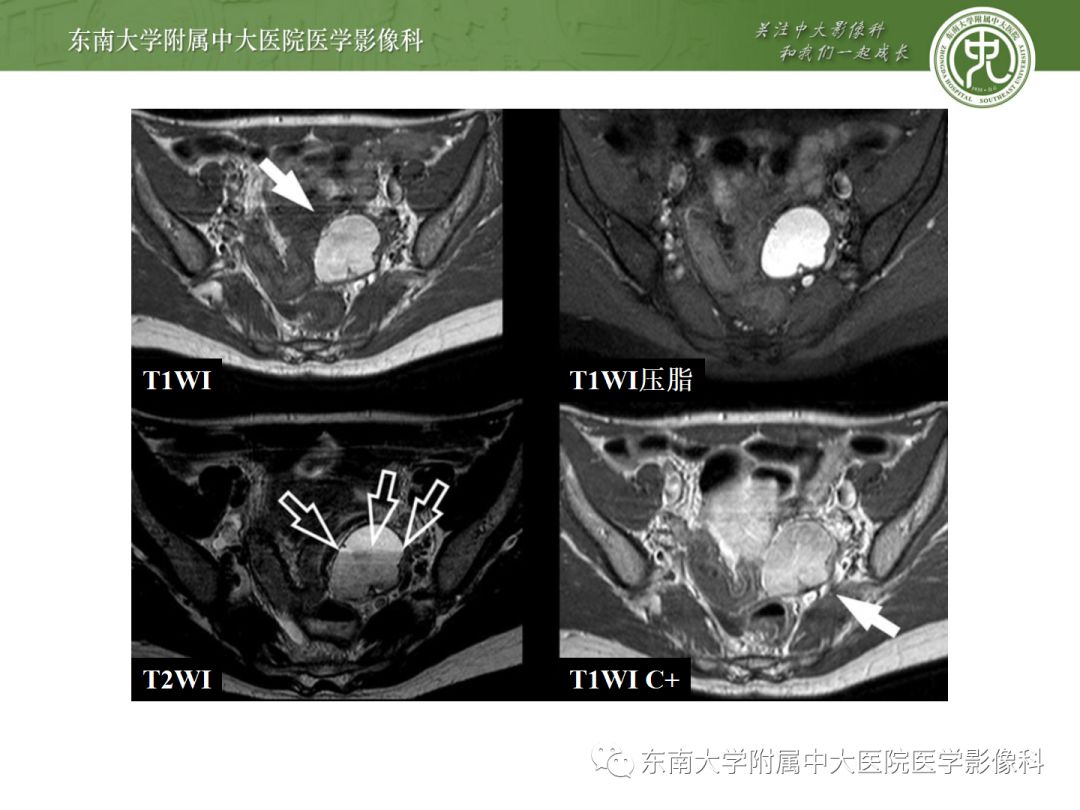 精彩推荐 | 子宫内膜异位症影像表现