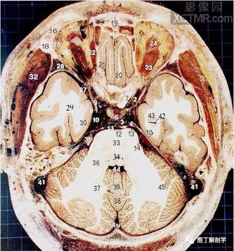 经典大体颅脑断层解剖图横断面