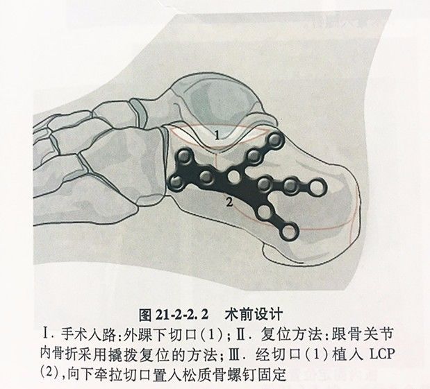 致右跟骨粉碎性骨折 手术关健是恢复关节面平整及bohler 角和gissane