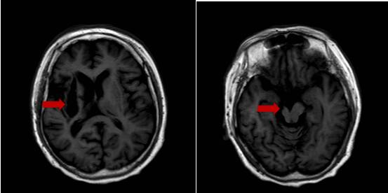病例2——患者,女,51岁,左侧脑出血病史,中脑,左侧大脑脚,内囊,放射冠