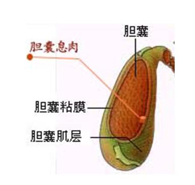 消瘀散调理胆囊息肉