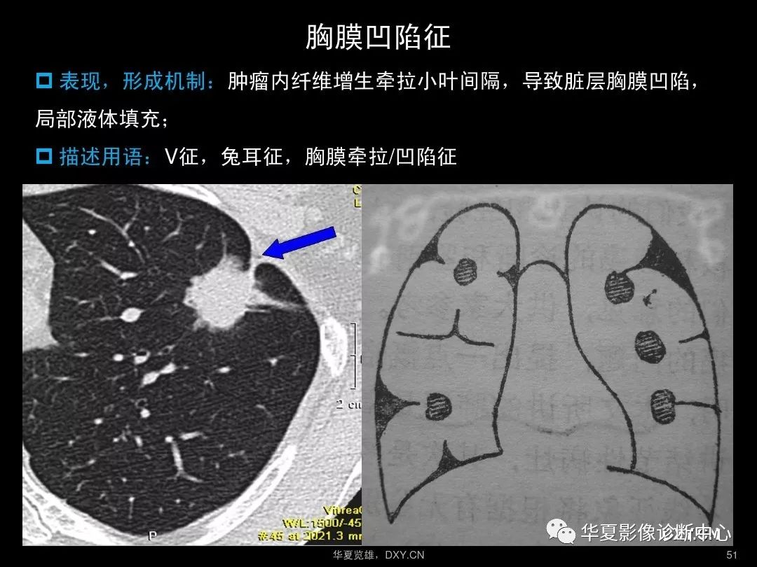 肺炎,肺结核,肺癌在ct及胸片上的区别