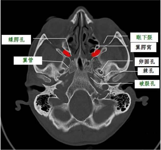 后壁:蝶骨大翼前面的下部和翼突根部(圆孔层面)