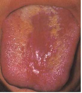 本图摄于一胃癌患者临终前二天,舌苔黑而燥裂,根部黑苔长如黑毛,舌体