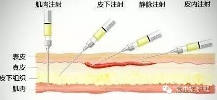 进针法与垂直进针法传统的进针方法为左手绷紧腹部皮肤,右手持注射器