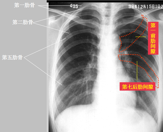 胸廓(肋骨,脊柱等)  认识肋骨是看胸片的基础,肺部病变常常以肋骨