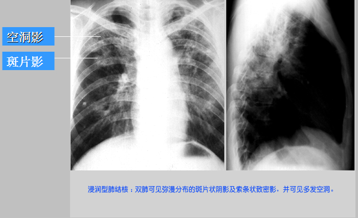 3,对异常x线影像的观察  位于肺尖的渗出性病变多为结核,而肺底部则