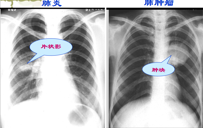 肺内斑片状,云絮状多为炎性病变;圆形影多为肿瘤 .