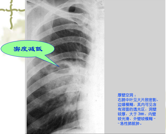 怎样阅读胸片