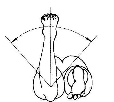 内翻,通常情况脚趾指向外b股骨内旋型:判断标准:髋内旋幅度正常或偏大