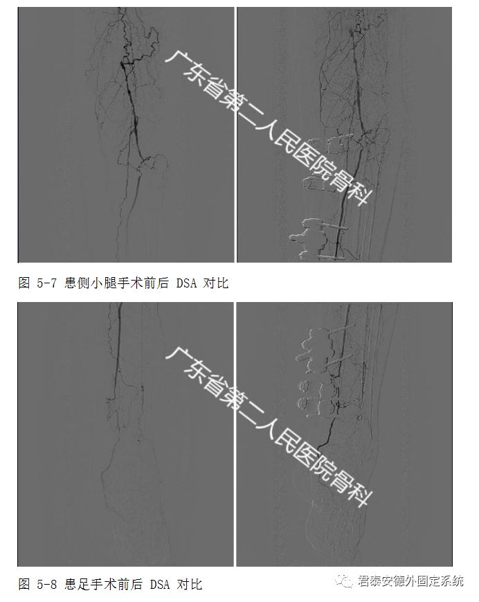 "横向骨搬运原理"应用案例及术后护理