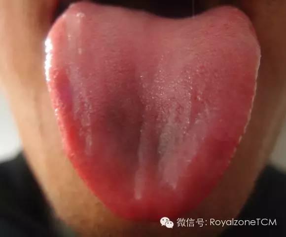 这是一例舌尖凹陷并双竖纹的舌头,竖纹下方见到暗红色瘀血.