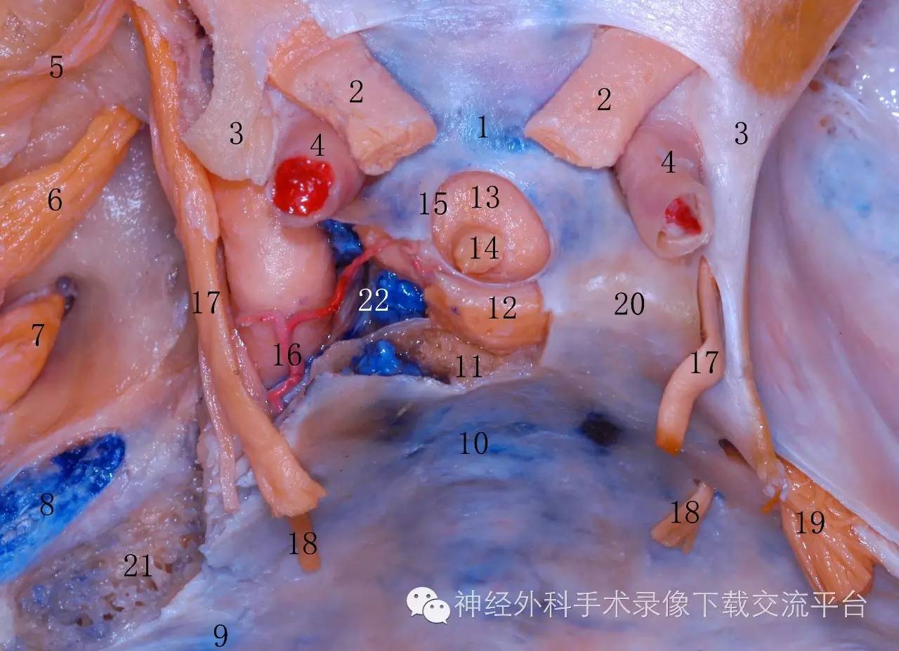 11鞍背(磨开)12垂体后叶13垂体前叶14垂体柄15鞍膈孔16脑膜垂体干17动