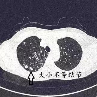 ct诊断肺结核宝典