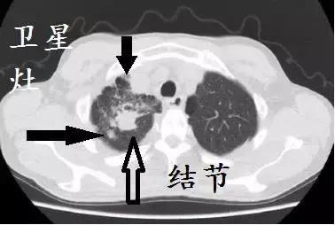 ct诊断肺结核宝典