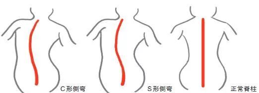 脊柱侧弯患者的脊柱则呈"c"形或者"s"形弯曲.