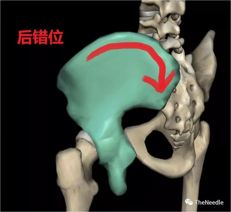 压痛点: 在髂后下棘下方,s2,s3旁 长短腿:趴着,腿变长