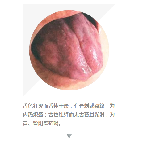 6 绛舌—热邪较盛