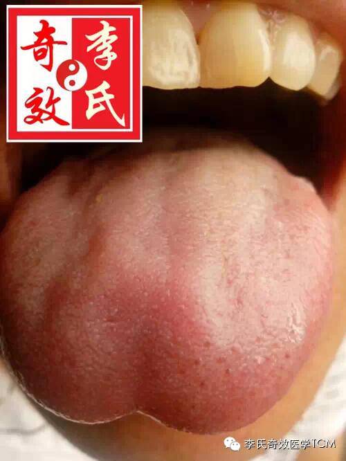 我们再讲一下这个舌尖的凹陷什么时候代表睡眠不好,什么时候代表腰痛.