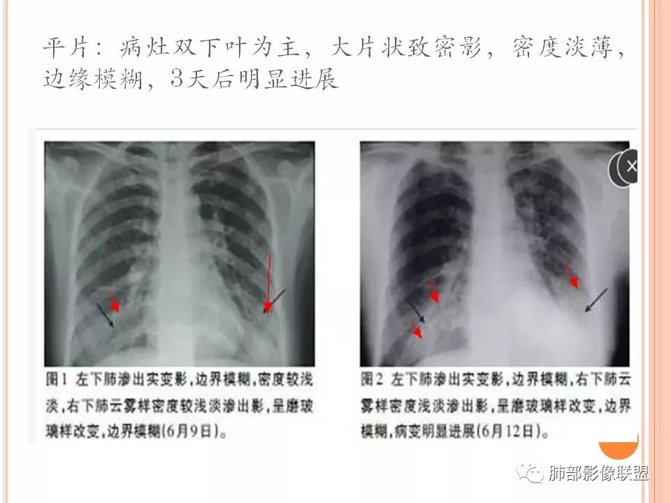 然后再朝着周围间质(小叶和肺泡间隔)发展(树雾征,ggo).