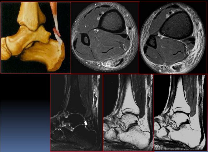 踝关节常见病变mri表现全总结