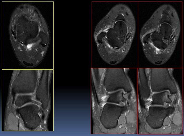 踝关节常见病变mri表现全总结