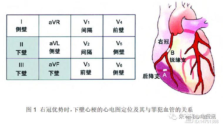 呈区域性分布,与病变冠脉给心肌供血的部位一致,因此通过心电图改变反