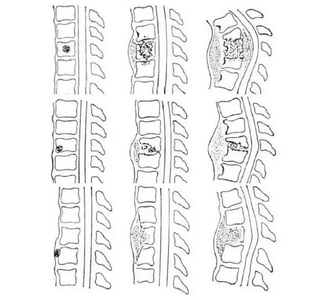 图1,23,韧带下型(椎旁型):病变在前纵韧一下扩展,椎体前缘骨质破坏,椎