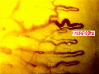 流动的白色微小血栓:在血流中出现的白色不规则的团块漂浮而过,成为