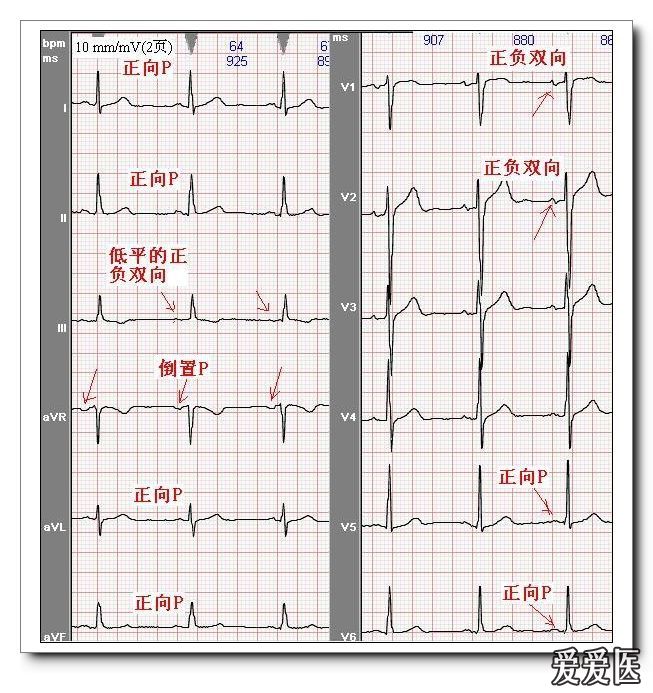 山羊老师课程常见心电图基础知识讲座第四讲p波方向来源分析