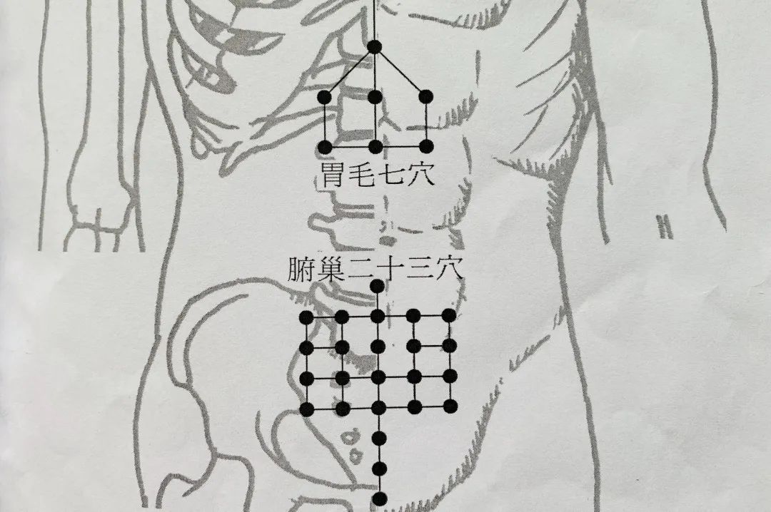 董氏針灸林正泰腑巢二十三穴瘦出你的小蠻腰