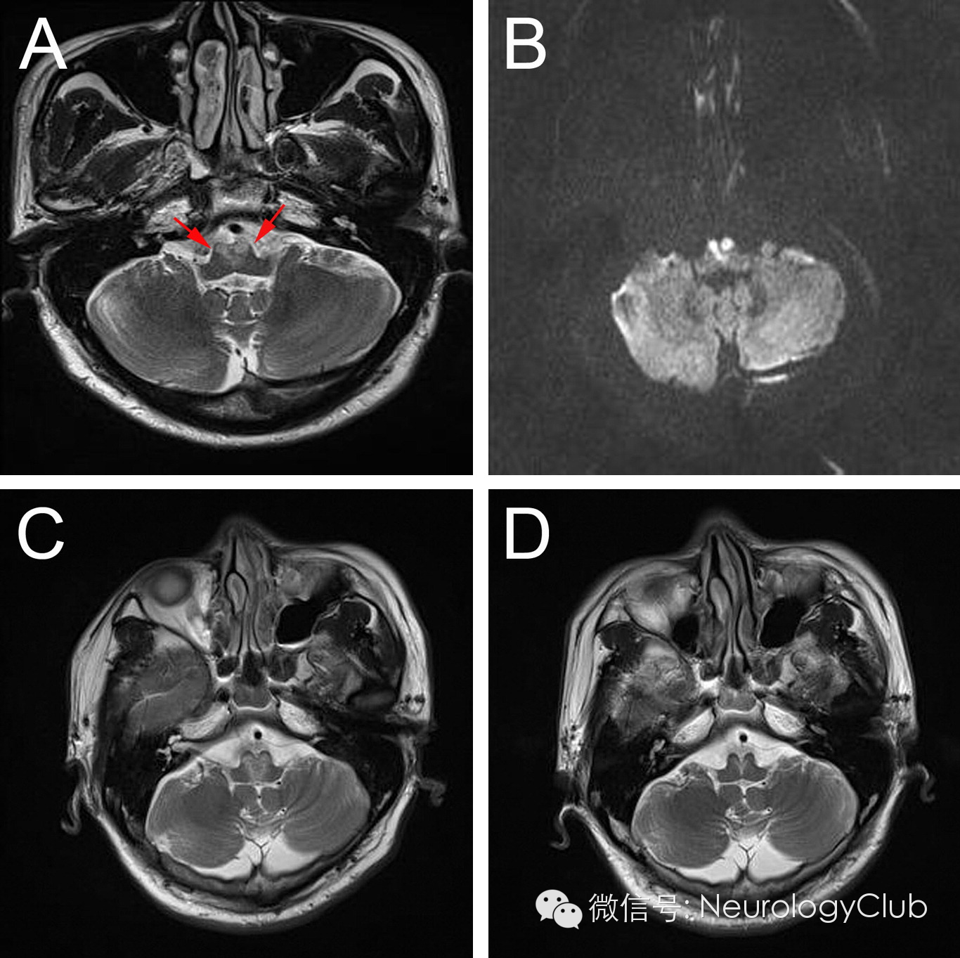 神经影像双侧延髓内侧梗死bilateralmedialmedullaryinfarction